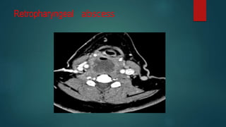 Retropharyngeal abscess
 