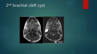 2nd brachial cleft cyst
 