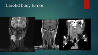 Carotid body tumor
 