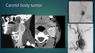Carotid body tumor
 