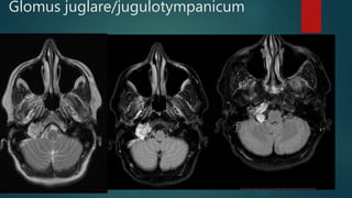 Glomus juglare/jugulotympanicum
 