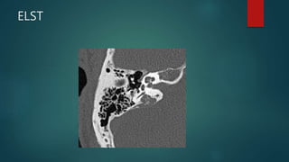 ELST
 