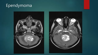 Ependymoma
 