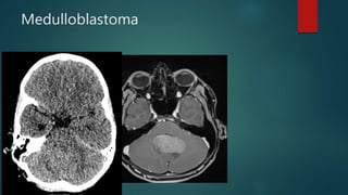 Medulloblastoma
 