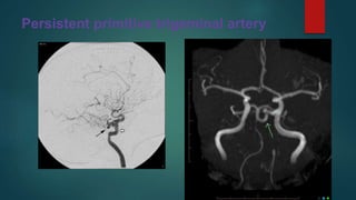 Persistent primitive trigeminal artery
 