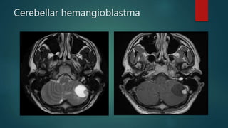 Cerebellar hemangioblastma
 
