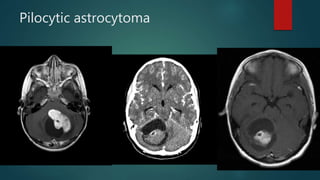 Pilocytic astrocytoma
 