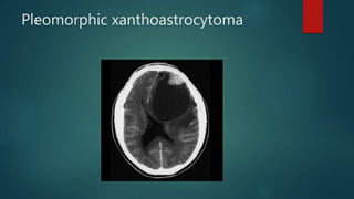 Pleomorphic xanthoastrocytoma
 
