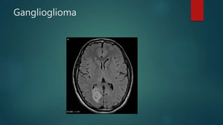 Ganglioglioma
 