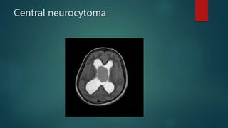 Central neurocytoma
 