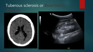 Tuberous sclerosis or Bourneville
disease
 