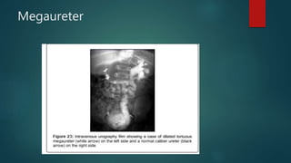 Megaureter
 