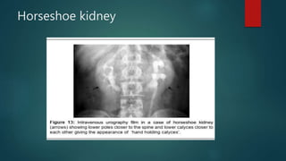 Horseshoe kidney
 