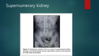 Supernumerary kidney
 