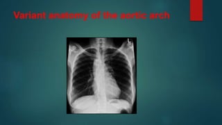 Variant anatomy of the aortic arch
 