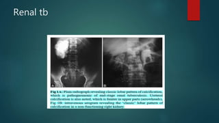 Renal tb
 