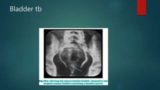 Bladder tb
 