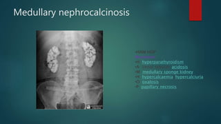 Medullary nephrocalcinosis
•HAM HOP
Mnemonic
•H: hyperparathyroidism
•A: (renal tubular) acidosis
•M: medullary sponge kidney
•H: hypercalcaemia/hypercalciuria
•O: oxalosis
•P: papillary necrosis
 