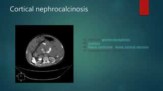 Cortical nephrocalcinosis
•G: (chronic) glomerulonephritis
•O: oxalosis
•A: Alport syndrome/ Acute cortical necrosis
•T: Transplant rejection (Chronic)
 