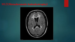 MLD(Metachromatic leukodystrophy)
 