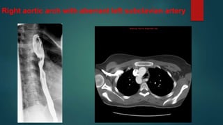Right aortic arch with aberrant left subclavian artery
 
