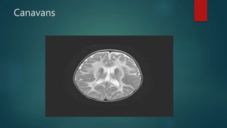 Canavans
 