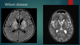 Wilson disease
 