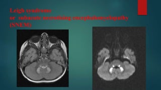 Leigh syndrome
or subacute necrotising encephalomyelopathy
(SNEM)
 