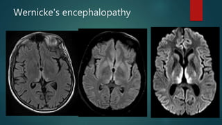 Wernicke's encephalopathy
 