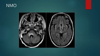 NMO
 