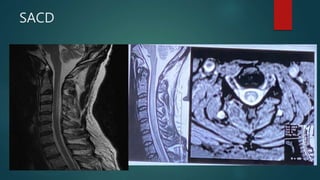 SACD
 