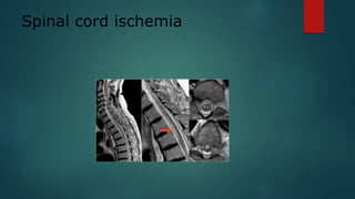 Spinal cord ischemia
 