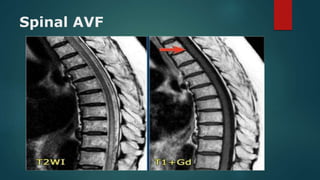 Spinal AVF
 