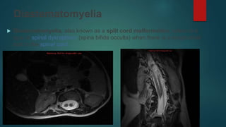 Diastematomyelia
 Diastematomyelia, also known as a split cord malformation, refers to a
type of spinal dysraphism (spina bifida occulta) when there is a longitudinal
split in the spinal cord.
 