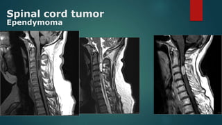 Spinal cord tumor
Ependymoma
 