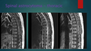Spinal astrocytoma - thoracic
 