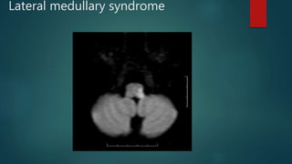 Lateral medullary syndrome
 