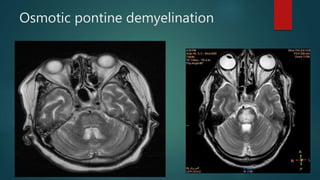 Osmotic pontine demyelination
 