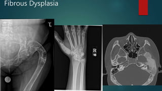 Fibrous Dysplasia
 