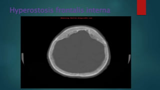 Hyperostosis frontalis interna
 