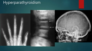 Hyperparathyroidism
 