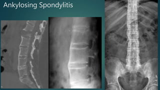 Ankylosing Spondylitis
 