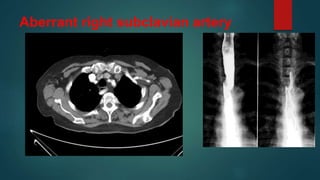 Aberrant right subclavian artery
 