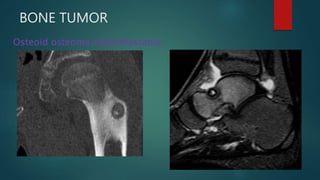BONE TUMOR
Osteoid osteoma/osteoblastoma
 