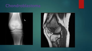 Chondroblastoma
 