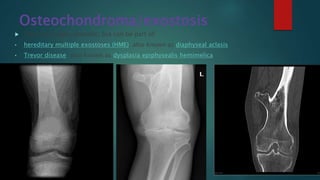 Osteochondroma/exostosis
 They are usually sporadic, but can be part of:
• hereditary multiple exostoses (HME): also known as diaphyseal aclasis
• Trevor disease: also known as dysplasia epiphysealis hemimelica
 