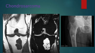 Chondrosarcoma
 