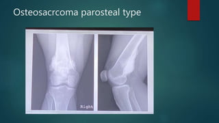 Osteosacrcoma parosteal type
 