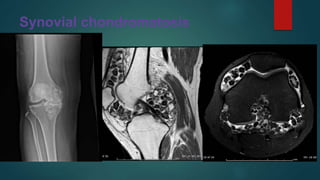 Synovial chondromatosis
 