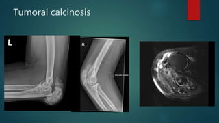 Tumoral calcinosis
 
